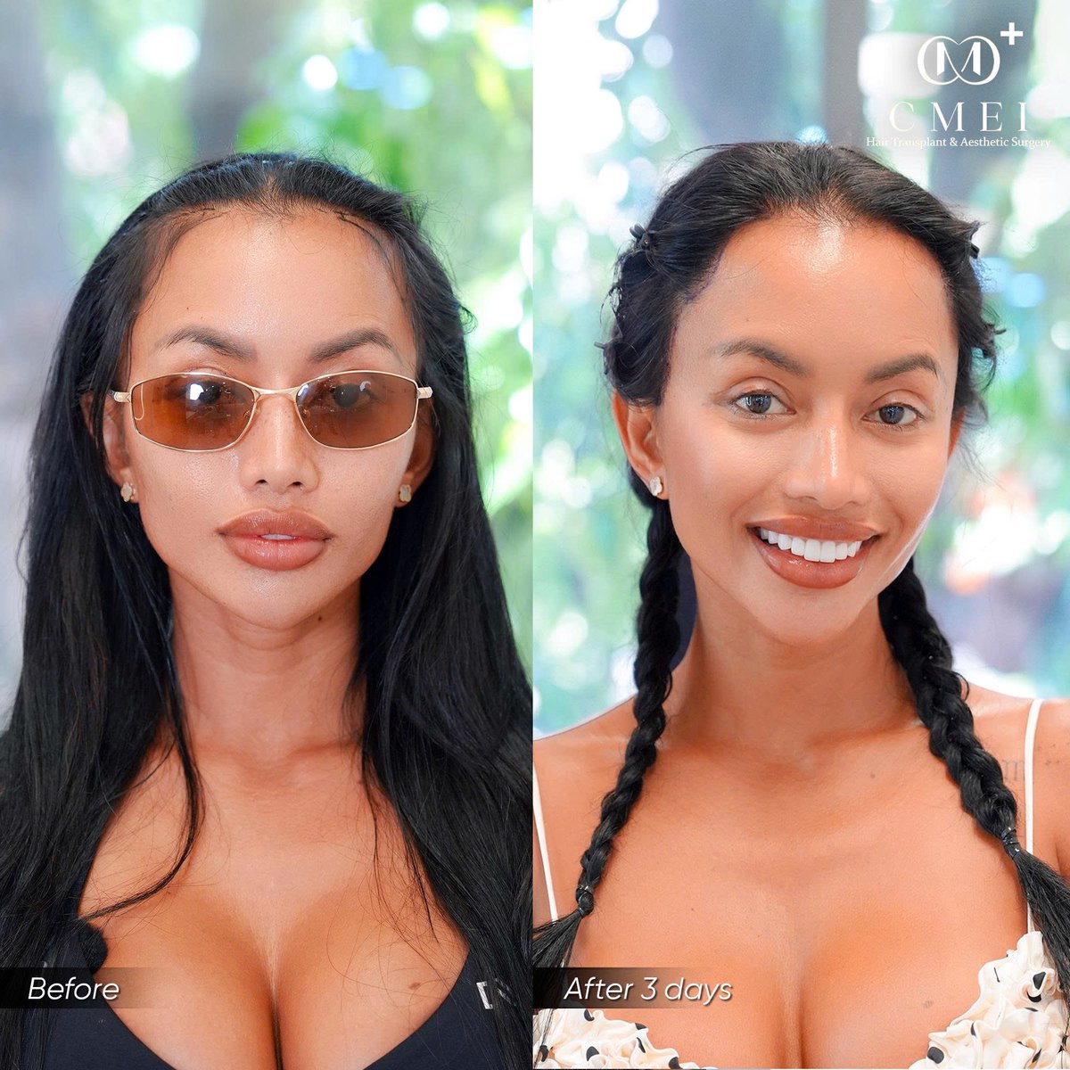 cmeimedical's tweet photo. CMEI Hair Transplant Vietnam
📍 24–26 Pham Ngoc Thach St., Xuan Hoa Ward, District 3, Ho Chi Minh City, Vietnam
 📞 Hotline | Wsapp | Zalo (+84) 799 928 668
📮 Wechat : Cmeimedicalgroup
📮 Line : Cmeimedicalgroup
🏥Website : https://t.co/1A0gU3oVfr
#hairtransplantvietnam https://t.co/S74lVoWp7B