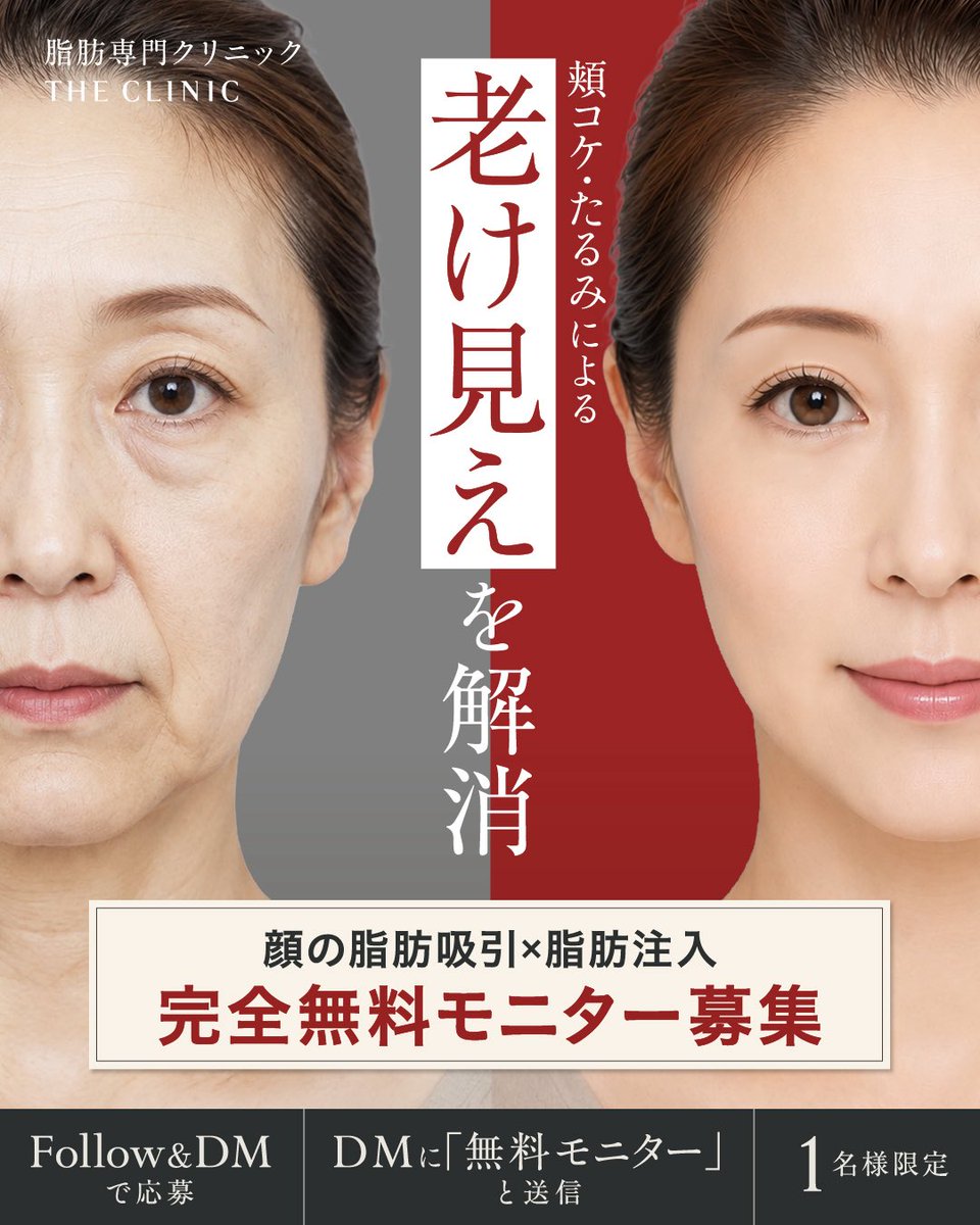 yuukitheclinic's tweet photo. 【顔の脂肪吸引＋脂肪注入｜施術モニター募集】

35歳以上の女性を対象に、
顔の脂肪吸引＋脂肪注入の施術モニターを募集します。

【募集内容】
・顔出しモニター：1名様／施術費無料
・顔出しなしモニター：50％OFF

【応募条件】
・施術前後の撮影にご協力いただける方
・THE CLINIC 東京院で施術を受けていただける方
・35歳以上の女性の方

【応募方法】
① 当アカウントをフォロー＆この投稿にいいね＆リポスト
② DMに自動で届く応募用リンクから必要事項を送信
選考後、対象となった方へ当クリニックよりご連絡いたします。

皆さまのご応募お待ちしております！