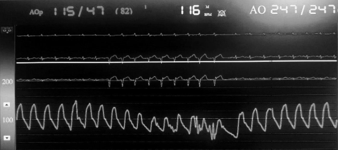 docsanz's tweet photo. @nadig_cardio Recently had 2 pts
Radial angio with TIG catheter underestimated ostioprox LMCA stenosis
EBU for PTCA-LMCA stenosis adequately imaged.Confirmed by IVUS
TIG catheter tapers &amp;has sidehole;engages easily,no pressure damping. In one case,QRS widening after contrast injection was clue https://t.co/JdOdsZLoa6