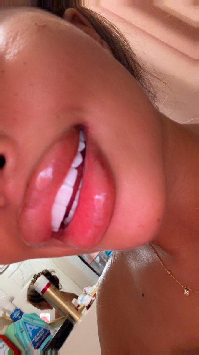 usermissnsky's tweet photo. Another 1ml of lip filler plumped in my lips 💉💉💉💉 so juicy and hot 👄👄👄 https://t.co/bkKnrA5hCT