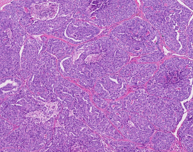 Janiranavarro's tweet photo. In the 2022 WHO Classification, poorly differentiated thyroid carcinoma (PDTC) is now grouped under high-grade follicular cell-derived non-anaplastic thyroid carcinoma (HGFCTC), alongside high-grade differentiated thyroid carcinoma (HGDTC)

Diagnosis of PDTC requires:
• Solid/trabecular/insular (STI) growth pattern 
• Absence of PTC nuclear features 
• ≥1 high-grade feature: mitosis >3/10 HPFs, necrosis, or convoluted (“raisin-like”) nuclei

Encapsulated poorly differentiated thyroid carcinoma (PDTC) with no invasion or limited invasion (capsular invasion or focal VI) has a more favorable outcome than widely invasive PDTC

These tumors should be subclassified as:
• Encapsulated with capsular invasion only
• Encapsulated angioinvasive
• Widely invasive

Always report encapsulation and extent of invasion. It may influence clinical management

Dr. Scognamiglio #USCAP #PathX #PathTwitter