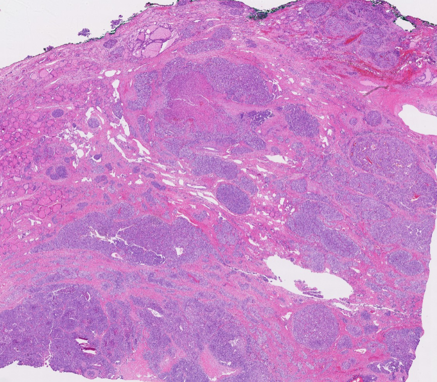 Janiranavarro's tweet photo. In the 2022 WHO Classification, poorly differentiated thyroid carcinoma (PDTC) is now grouped under high-grade follicular cell-derived non-anaplastic thyroid carcinoma (HGFCTC), alongside high-grade differentiated thyroid carcinoma (HGDTC)

Diagnosis of PDTC requires:
• Solid/trabecular/insular (STI) growth pattern 
• Absence of PTC nuclear features 
• ≥1 high-grade feature: mitosis >3/10 HPFs, necrosis, or convoluted (“raisin-like”) nuclei

Encapsulated poorly differentiated thyroid carcinoma (PDTC) with no invasion or limited invasion (capsular invasion or focal VI) has a more favorable outcome than widely invasive PDTC

These tumors should be subclassified as:
• Encapsulated with capsular invasion only
• Encapsulated angioinvasive
• Widely invasive

Always report encapsulation and extent of invasion. It may influence clinical management

Dr. Scognamiglio #USCAP #PathX #PathTwitter
