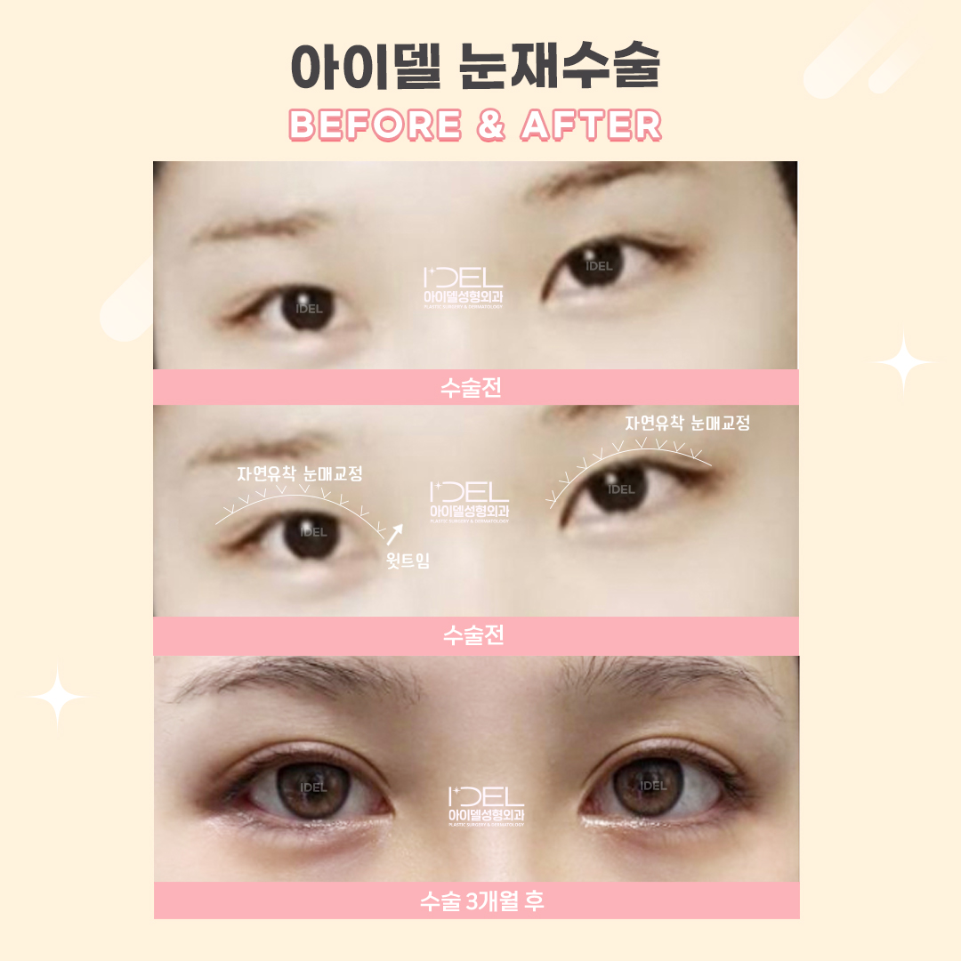idelprs_kr's tweet photo. 아이델에서 [자연유착 눈매교정재수술, 윗트임 3개월차] 된 고객님의 후기예요 😊 

#자연유착 #눈재수술 #アイデル美容外科 https://t.co/TlR3gkxZom