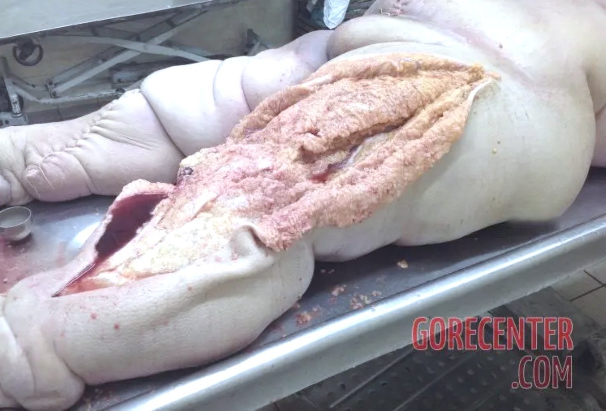 moriitician's tweet photo. obesity in an autopsy.
ai generated / sfx art https://t.co/al7Jg50e3d