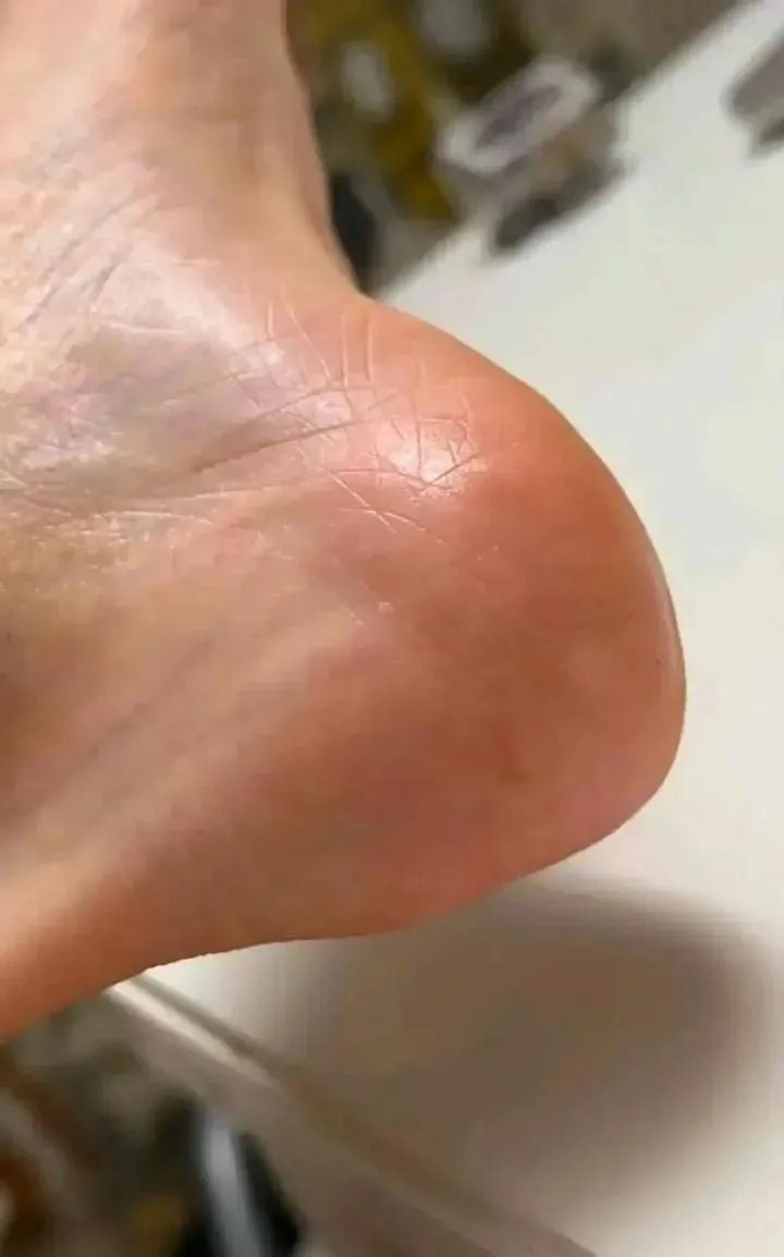 Amudemaisy's tweet photo. Achei que não funcionaria por ser tão barato, mas a indicação da minha dermato foi certeira! Adeus vergonha de andar descalça ou de rasteirinha. Tô mega feliz! 🥰 https://t.co/gKL1PUO2Kl