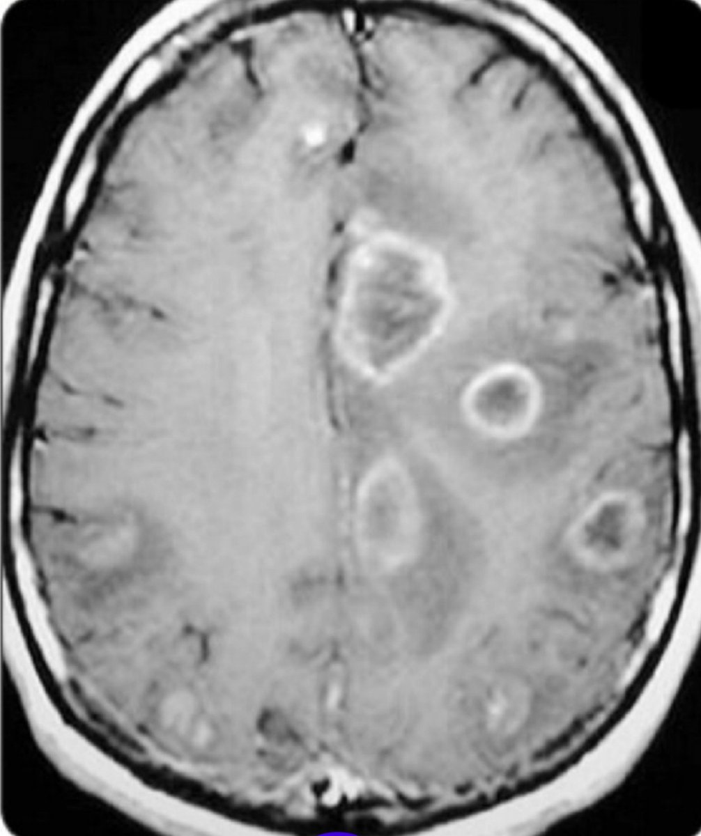 Doctors_GUILD's tweet photo. A brain shows multiple ring-enhancing lesions with surrounding edema in the cerebral hemispheres of a 35-year-old HIV-positive patient with fever and seizures.

Diagnosis?

A) Toxoplasmosis

B) Glioblastoma

C) Neurocysticercosis

D) Meningioma https://t.co/eUsIhbEdk9