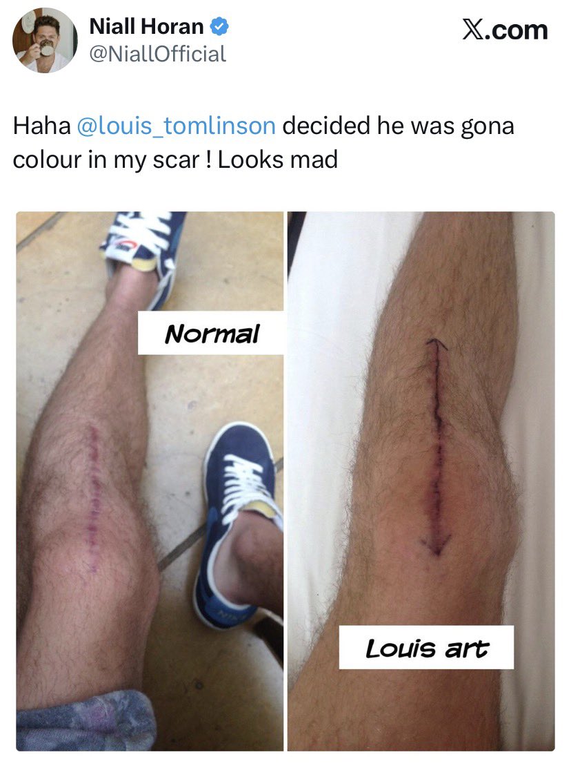 NHGALLERY93's tweet photo. how cute was niall for tweeting that louis tomlinson had drawn on his knee scar back in 2014 😭😭 https://t.co/HW3YJBeFhZ