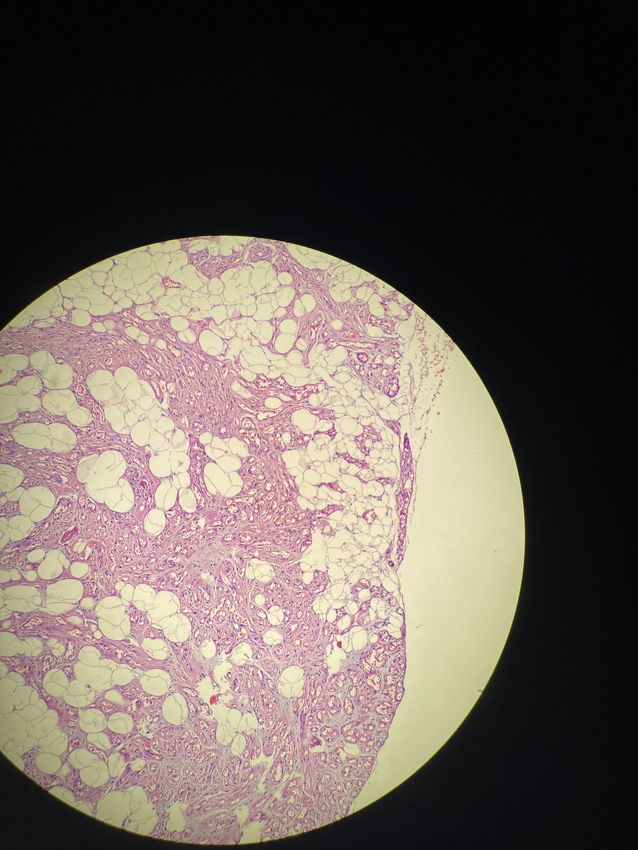 drtugcecay's tweet photo. Angiolipoma #pathology #pathtweet https://t.co/W2iB9aAOPa