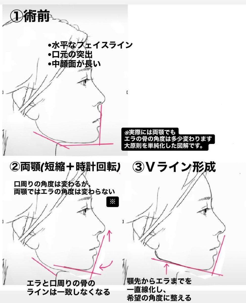 Satoru_ORTO's tweet photo. 良い視点だと思いますのでお答えさせて下さい！

①下顔面が短くなる＋時計回転で角度がつく、は両立します。
②両顎で動くのは口元の骨で、エラの角度自体は原則的には変わりません。

Ｖラインを併用しない保険の術後のCTを見ると、多くの症例でエラの骨と口元の骨のラインに角度がついてしまっているのが分かります。

③だからこそ、Ｖライン形成を併用し、口元からエラまでを一直線化し、任意の角度に整えます。

だからこそ、私は両顎単体で行うことは殆どなく、Ｖラインなど輪郭骨切りと併用します。

なので、中顔面の短縮と時計回転やＶラインと合わせてデザインすることで、フェイスラインの角度は調整可能です。ご安心下さいませ。