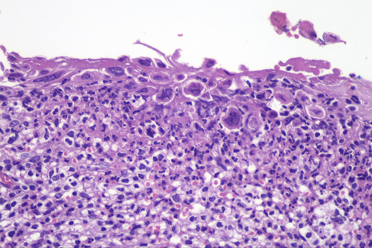 surgpathcases's tweet photo. Cervix, 30y

#pathology #patologia #gynpath #gynpathology https://t.co/T0AElVw34P