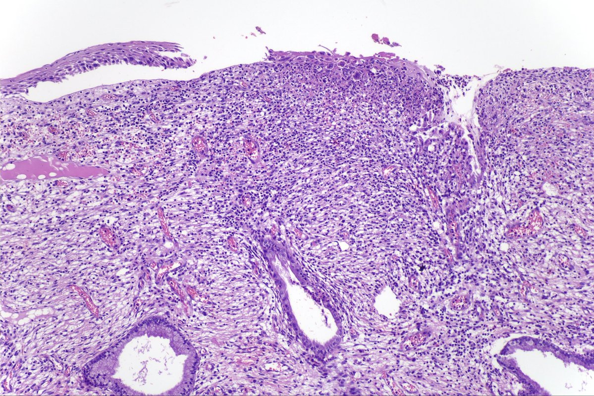 surgpathcases's tweet photo. Cervix, 30y

#pathology #patologia #gynpath #gynpathology https://t.co/T0AElVw34P