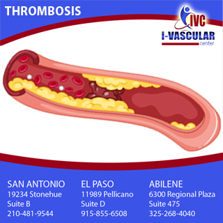 Ivascularcenter's tweet photo. Deep Vein Thrombosis occurs when blood clots form in the deep veins of your body resulting in pulmonary embolism and possibly death. If a blood clot loosens and travels through your bloodstream, it can lodge in your lungs cutting off blood flow completely. https://t.co/4pA2YYlwGw https://t.co/OzKK1RXFTB