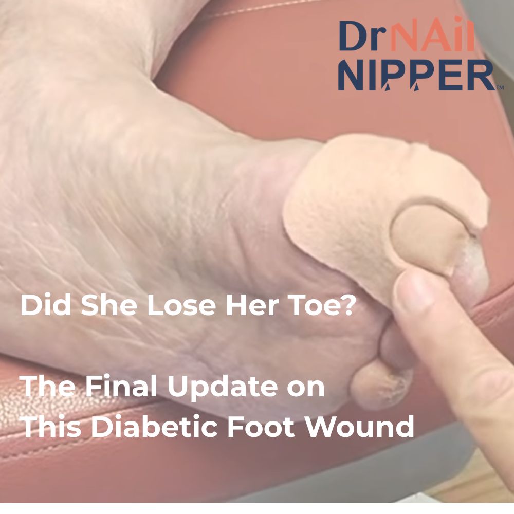 drnailnipper's tweet photo. Did She Lose Her Toe? The Final Update on This Diabetic Foot Wound https://t.co/lH2ChMcrtv

@MiamiRadioBeast @PodiatryToday @PodiatryTrends https://t.co/e7xpChB72E