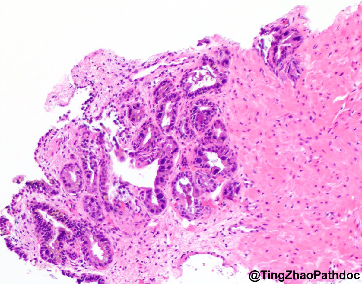 TingZhaoPathdoc's tweet photo. Location and diagnosis?

#PathTwitter @MGBpathology https://t.co/qQE8JtSiFs