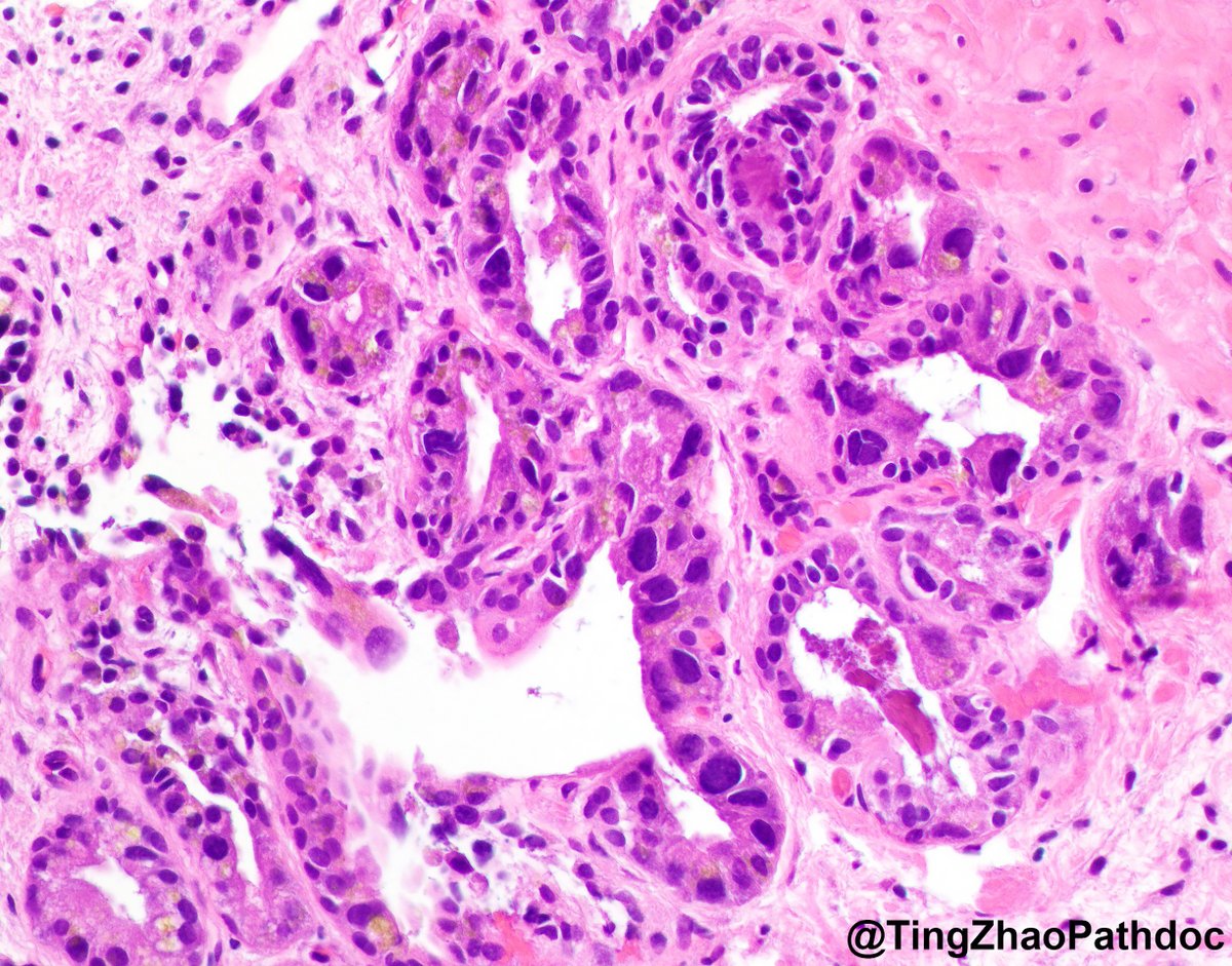 TingZhaoPathdoc's tweet photo. Location and diagnosis?

#PathTwitter @MGBpathology https://t.co/qQE8JtSiFs