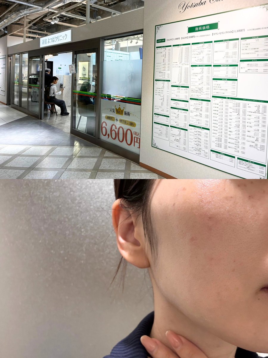 anmitsu__life's tweet photo. 5,000円台でシミ取り放題の「よつば会」
ここは忖度なしでガチおすすめ___ ✍︎
シミに課金してる人はレーザー当てちゃう方がコスパ良い��す、術後はツリーで詳しく語る⤵︎ https://t.co/Qec7t7uIb0