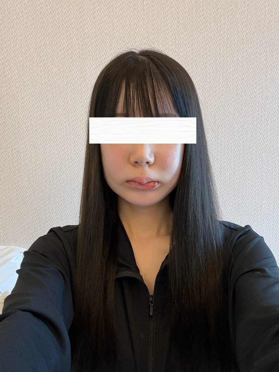 xq20ae's tweet photo. MACS 両顎+輪郭3点
DT3日目 https://t.co/IYG5ip2Ve8