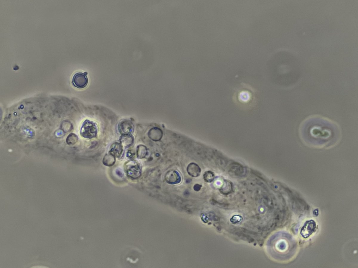 zaheeramin1's tweet photo. Acanthocyte and RBC casts in pt with MPO Vasculitis (phase contrast 1000X) #UrinarySediment #UrineMicroscopy https://t.co/Ua1A0u6Wx7