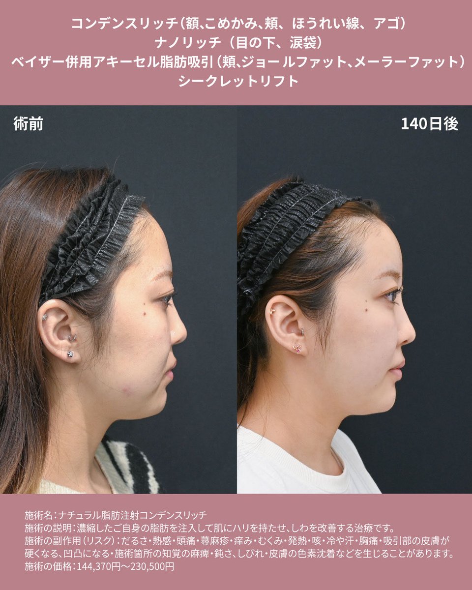 sbc_takesako's tweet photo. 骨切り後のたるみ、クマ取り後の目の下の凹みがお悩みで、脂肪吸引×脂肪注入×糸リフトを行いました✨
ゴツゴツ輪郭から卵形の輪郭になり、多幸感のあるメリハリ小顔になりました✨

脂肪吸引後は、半年後まで徐々に引き締まります🤫
徐々に変化することで周囲にバレづらいのもメリットですね☺️ https://t.co/KELdtK4kRh