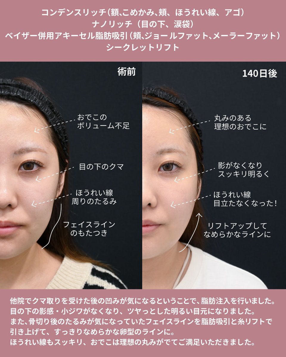 sbc_takesako's tweet photo. 骨切り後のたるみ、クマ取り後の目の下の凹みがお悩みで、脂肪吸引×脂肪注入×糸リフトを行いました✨
ゴツゴツ輪郭から卵形の輪郭になり、多幸感のあるメリハリ小顔になりました✨

脂肪吸引後は、半年後まで徐々に引き締まります🤫
徐々に変化することで周囲にバレづらいのもメリットですね☺️ https://t.co/KELdtK4kRh
