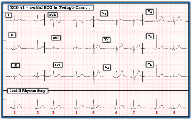 ekgpress's tweet photo. The ECG in the Figure is from a man in his 60s who is aware of his “irregular heart beat”. — Why is this rhythm irregular? — What is your differential diagnosis? — GO TO — https://t.co/CuTZVMvalV — :) https://t.co/qlvfoPa3jR