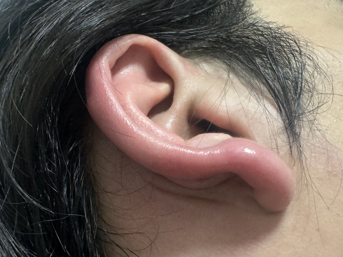 MitchellNoviter's tweet photo. 先週末、右耳が腫れ上がり（外耳道炎？）、喉痛・咳・痰が出てきて、完全に体調を崩しまして・・・

発熱はないけど、また声が嗄れました！折角、頑張って声の調子を戻したのに、残念！
去年2025年も、夏風邪を引いてたようです！定期的な体調不良をなんとかしないといけないよなぁ・・・（しみじみ） https://t.co/pJO6X4HbP2