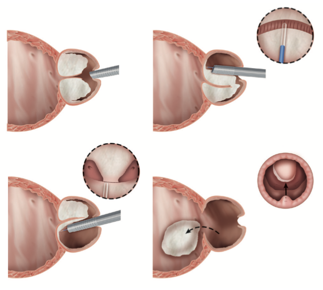 holepsurgery's tweet photo. HoLEP takes the obstructing prostate out in one piece, like peeling an orange. It does not chip it or burn it away.

Any size. Catheter usually out at 24 hours. Home in 1–2 nights.

Not TURP. Not GreenLight. Not Rezum.

https://t.co/hODJ1nGbAp https://t.co/fLu2HRokSa