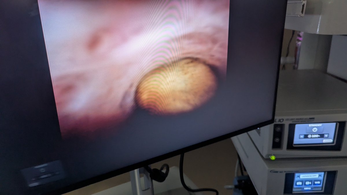SurgOnc_Sam's tweet photo. Robotic chole with common bile duct exploration with spyglass and intraop ultrasound (as sensitive as IOC and more specific). Single strange duct clearance with chole saves patients LOS and extra procedures. https://t.co/HvSJuJg9oz