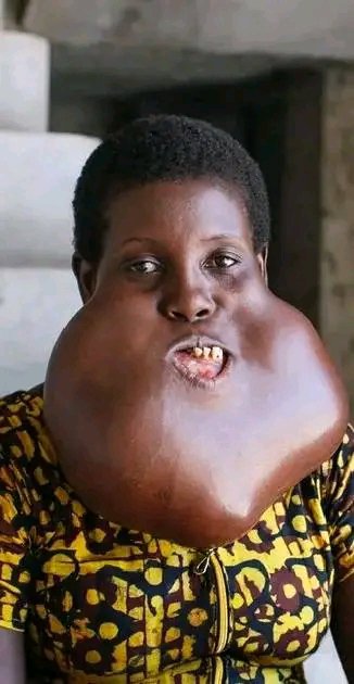 Andersoncolem13's tweet photo. Surgeons deserve all the flowers💐

For over 20 years, Charity carried a massive swelling. What began as a small bump grew into a life-threatening jaw tumor (ameloblastoma) that nearly suffocated her.

She eventually received free, life-saving surgery https://t.co/QM5okpfSiF