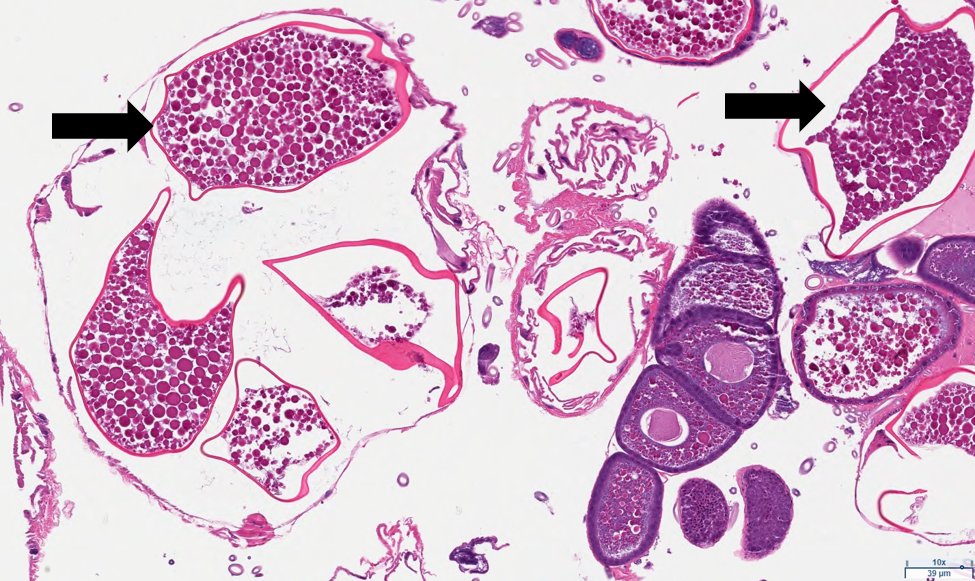 ParasiteGal's tweet photo. The answer to #Parasite Case 814 is up by Jacob Rattin: Tunga penetrans – the only flea that can embed itself into human skin. Read the description here: https://t.co/jdAEaGyzOw #mayopath #pathology #PathBugs #parasitology https://t.co/WONZRqgvJ3