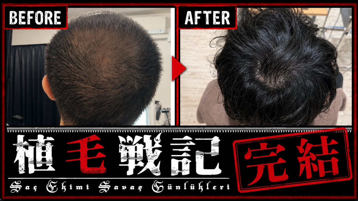 bamboo_milktub's tweet photo. 1年4ヶ月、40,000文字以上の長きに渡る人体実験レポート「トルコで植毛してみた」、堂々完結。

完結を記念して全編無料公開します。
ハゲでお悩みの貴兄達は暇つぶしに読んでちょ。

※なおPRでも宣伝でもなんでもなく、興味本意で植毛受けた男の人体実験レポートです。 https://t.co/vg5w8LXyHS