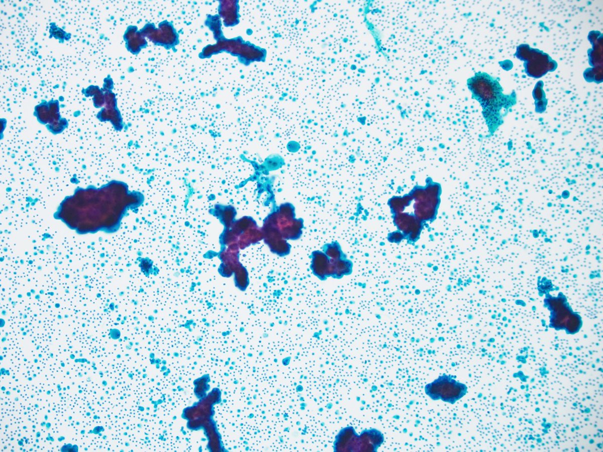 CytoPapGuy's tweet photo. Today’s Cytopath finding: 
CANON BALLS! 
What do they mean? Or are they just pretty to look at? 
70 M, 2 cm lung lesion, no CA history

Pap stain and Cell Block 

#pathology #cytology #cytopathology #resident #pathologyresident #medschool #medicalresident #Cytopath #med https://t.co/0Bn3cWGxPl