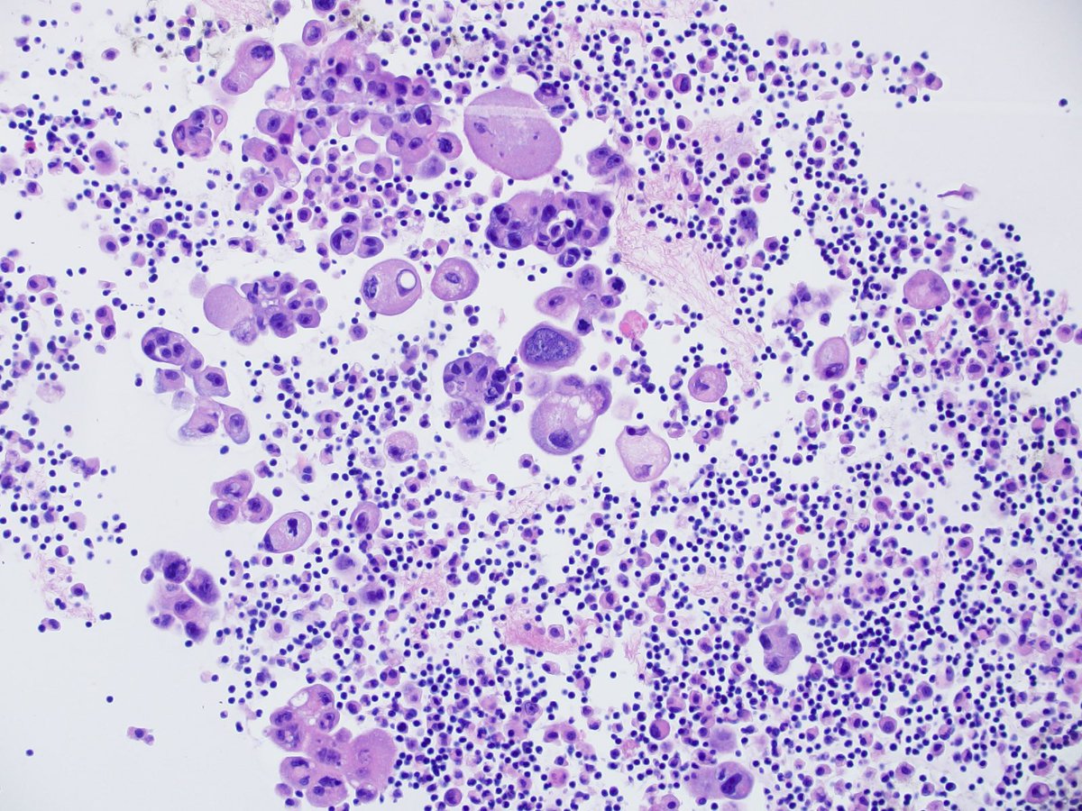 CytoPapGuy's tweet photo. Today’s Cytopath finding: 
CANON BALLS! 
What do they mean? Or are they just pretty to look at? 
70 M, 2 cm lung lesion, no CA history

Pap stain and Cell Block 

#pathology #cytology #cytopathology #resident #pathologyresident #medschool #medicalresident #Cytopath #med https://t.co/0Bn3cWGxPl