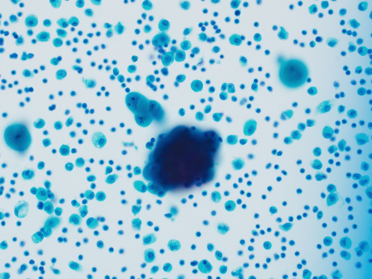 CytoPapGuy's tweet photo. Today’s Cytopath finding: 
CANON BALLS! 
What do they mean? Or are they just pretty to look at? 
70 M, 2 cm lung lesion, no CA history

Pap stain and Cell Block 

#pathology #cytology #cytopathology #resident #pathologyresident #medschool #medicalresident #Cytopath #med https://t.co/0Bn3cWGxPl