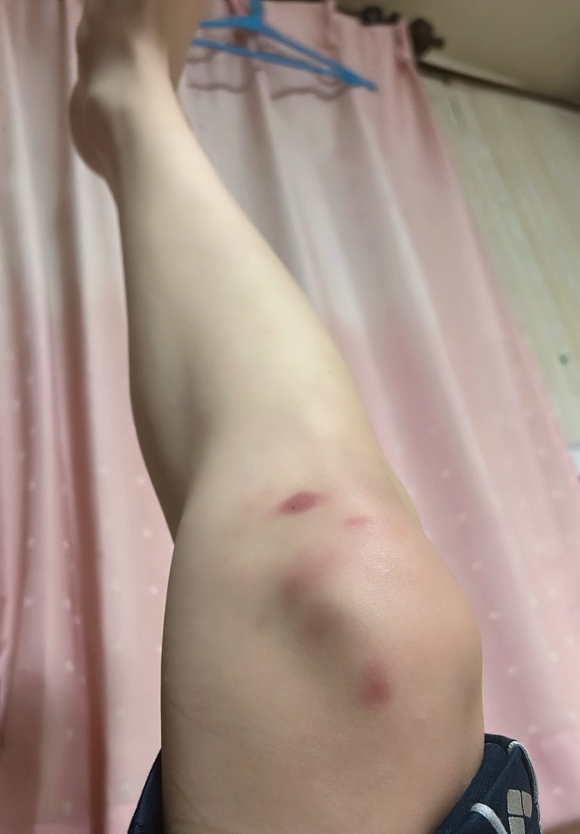 sushiko_cell's tweet photo. せくちーだんすには膝あざはつきもの https://t.co/NQD7LW7DHO