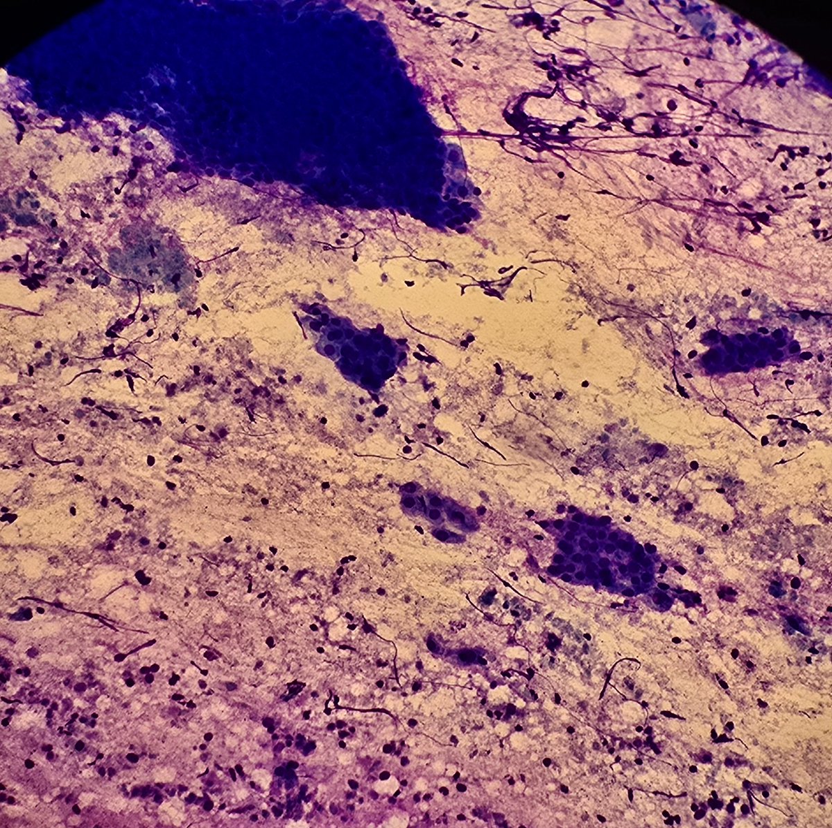 ahmedpath1's tweet photo. Learning a lot in my first year!  Interesting (to me at least) cytology case of a Warthin tumor in the parotid gland (debated if a was a WARTHY first post 😂).
#PathTwitter #pathology #PathX https://t.co/i6Ydj4iljp