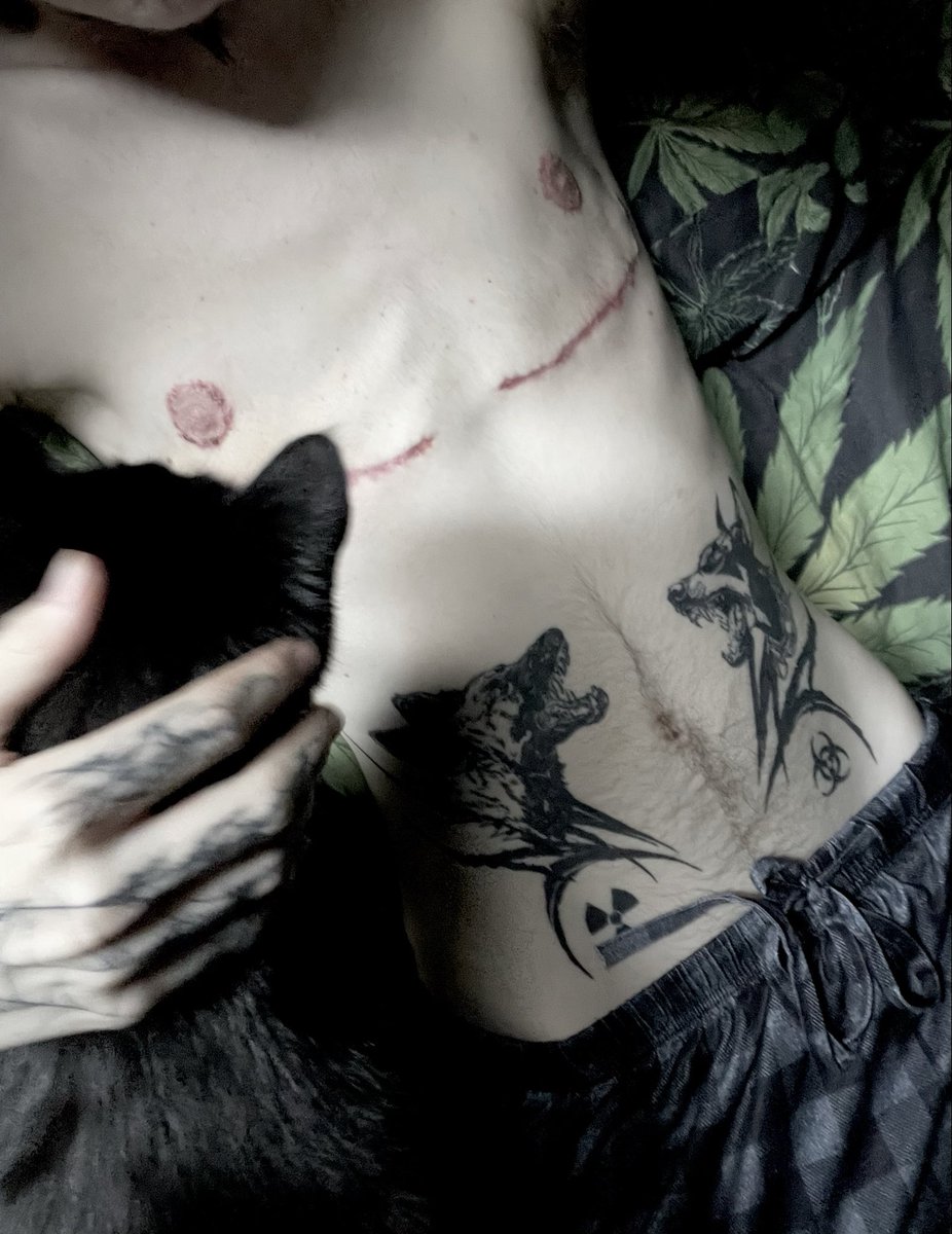 crypttoxx's tweet photo. Just over 5 weeks post op, can’t believe time has gone so fast https://t.co/KdUV2nHiN6
