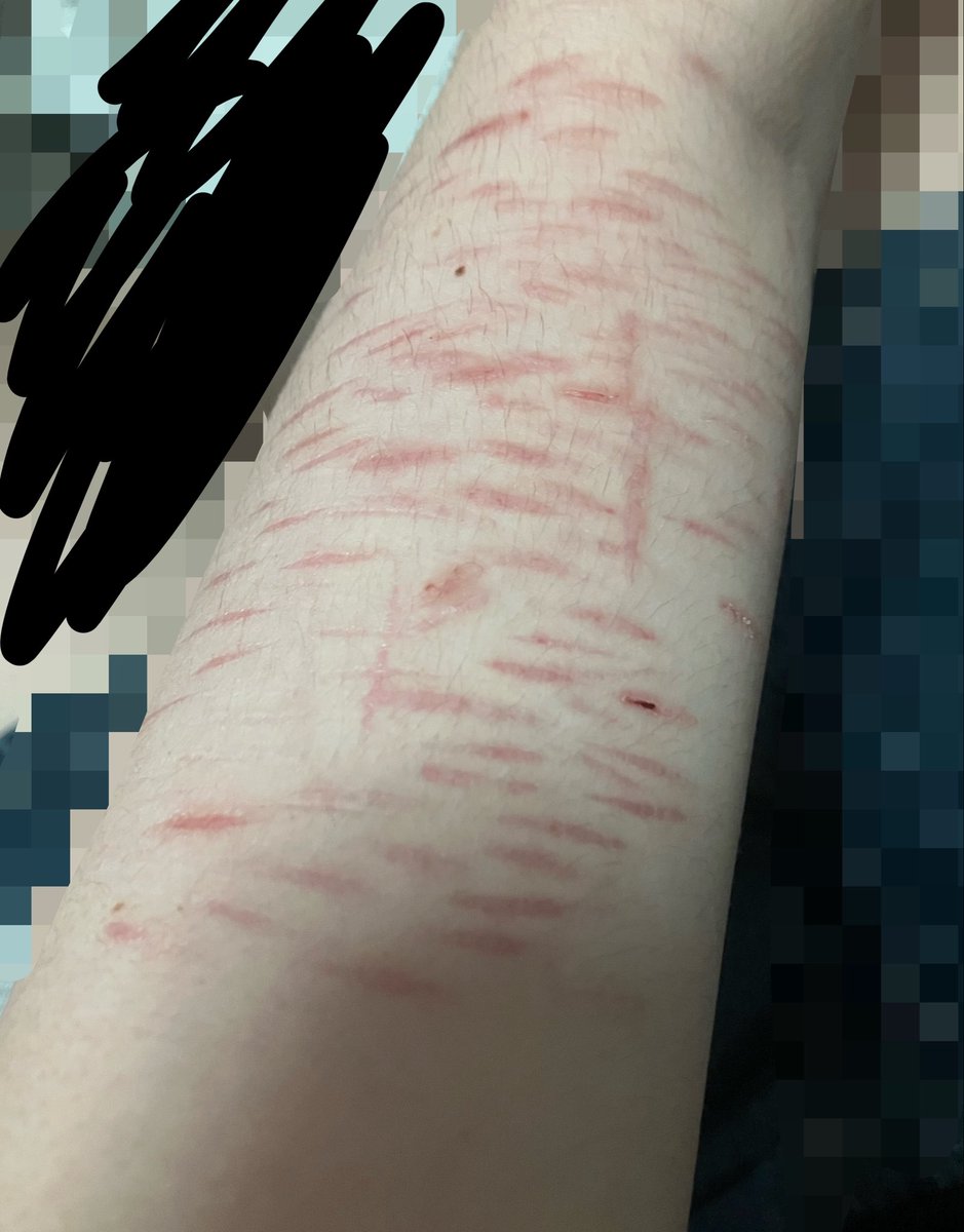 fvcking_w3ird0's tweet photo. TW HEALED SH #shhtwt 

the first 2 pictures are from june and the last one is from like 20 days ago
im pretty sure they’re just styros but some of them are keloids and its weird that they still look like that.
also is it okay to go outside like this? im tired of covering them.. https://t.co/Q373SylkAH