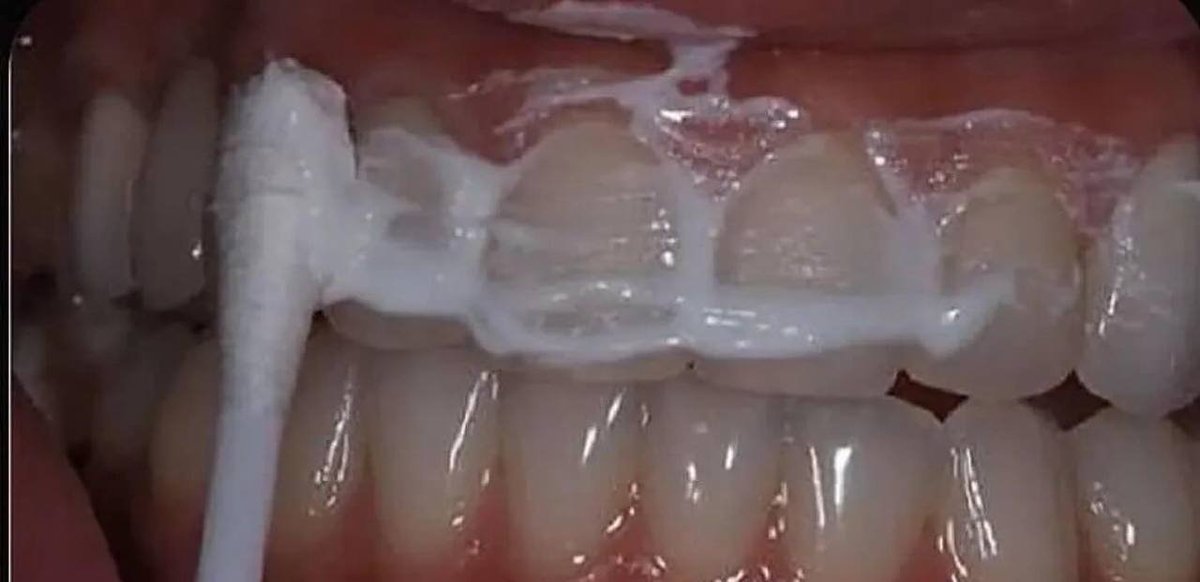 hmzah1u's tweet photo. كيفية تبييض #الأسنان دون إلحاق الضرر بها
⠀
🦷 تساعد هذه الطريقة في علاج معظم أمراض اللثة، وفي الوقت نفسه، تقوم بتبييض الأسنان تقريبًا على الفور، وتزيل الجير، وتعالج الجروح الصغيرة في الفم.

تساعد في علاج أمراض اللثة، وأمراض الجذور، والسواد في جذور الأسنان، والجير، وأي حالة مؤلمة في الفم.
⠀
🦷 تحتاج إلى تحضير معجون بسيط: أضف 10-20 قطرة من بيروكسيد الهيدروجين (من الصيدلية تركيز 3٪) وعدد قليل من قطرات الليمون إلى نصف ملعقة صغيرة من صودا الخبز.

🦷 اغمس فرشاة الأسنان في المعجون، وافرك الأسنان واللثة من الداخل والخارج بهذا المعجون. الليمون يوازن صودا الخبز ويمنح انتعاشًا، وصودا الخبز تنظف الأسنان من البلاك، والبيروكسيد يطهر ويبيض.
⠀🪻🪻🪻