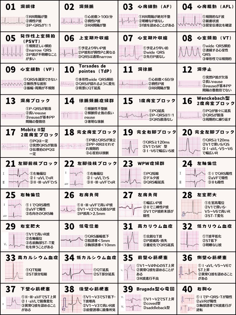ecgkuma's tweet photo. 心電図を学びはじめたあなたへ

基本的な波形を40個
1枚の図解にまとめました

心電図を勉強していると

「この波形、どこを見るんだっけ？」
「名前は聞いたことあるけど、特徴が出てこない」
「似た波形が増えてきて、頭の中がごちゃごちゃする」

みたいなことが必ず出てきます

最初から細かい診断基準を
全部覚える必要はありません

まずは

「この波形なら、ここを見る」

という代表的な特徴を
押さえるところからでOKです

今回まとめた40個について
波形のポイントも簡単に置いておきます↓

01｜洞調律
①RR間隔が整
②洞性P波
③P-QRSが1：1

02｜洞頻脈
①心拍数＞100/分
②洞性P波
③RR間隔が整

03｜心房細動（AF）
①RR間隔が絶対不整
②明瞭なP波なし
③f波を認めることがある

04｜心房粗動（AFL）
①規則的なF波
②鋸歯状波
③房室伝導比を確認

05｜発作性上室頻拍（PSVT）
①規則正しい頻拍
②narrow QRS
③P波が不明瞭なことが多い

06｜上室期外収縮（PAC）
①予定より早いP波
②洞性P波と形が異なる
③QRSは通常narrow

07｜心室期外収縮（PVC）
①予定より早い拍
②wide QRS
③先行P波なし

08｜心室頻拍（VT）
①wide QRS頻拍
②連続する心室性QRS
③単形性では規則的

09｜心室細動（VF）
①QRSを識別できない
②無秩序な波形
③振幅・周期が不規則

10｜Torsades de pointes（TdP）
①多形性wide QRS頻拍
②QRSが捻れるように変化
③背景にQT延長

11｜洞徐脈
①心拍数＜60/分
②洞性P波
③RR間隔が整

12｜洞停止
①突然P波が欠落
②長いpause
③pauseが基本PP間隔の整数倍でない

13｜洞房ブロック
①P-QRSが脱落
②長いpause
③pauseが基本PP間隔の整数倍

14｜徐脈頻脈症候群
①頻脈性不整脈
②頻脈停止後の長いpause
③著明な徐脈

15｜1度房室ブロック
①PQ延長
②P-QRSは1：1
③QRS脱落なし

16｜Wenckebach型2度房室ブロック
①PQが徐々に延長
②QRSが脱落
③周期的に繰り返す

17｜Mobitz II型2度房室ブロック
①PQは一定
②突然QRSが脱落
③伝導拍のPQは一定

18｜完全房室ブロック
①P波とQRSが独立
②PP・RRはそれぞれ規則的
③心室拍は徐脈

19｜完全右脚ブロック
①QRS≧120ms
②V1でrSR′型
③Ⅰ・V6で幅広いS波

20｜完全左脚ブロック
①QRS≧120ms
②V1で深いS／QS
③Ⅰ・aVL・V5〜V6で幅広いR

21｜左脚前枝ブロック（LAFB）
①左軸偏位
②Ⅰ・aVLでqR
③Ⅱ・Ⅲ・aVFでrS

22｜左脚後枝ブロック（LPFB）
①右軸偏位
②Ⅰ・aVLでrS
③Ⅱ・Ⅲ・aVFでqR

23｜WPW症候群
①PQ短縮
②デルタ波
③QRS幅延長

24｜左軸偏位
①ⅠでQRS陽性
②aVFで陰性
③Ⅱも陰性

25｜右軸偏位
①ⅠでQRS陰性
②aVFで陽性
③右向きのQRS軸

26｜右房負荷
①Ⅱ・Ⅲ・aVFで高いP波
②V1〜V2でも尖鋭なP波
③P波高＞2.5mm

27｜左房負荷
①幅広いP波
②Ⅱで二峰性P波
③V1でP波終末部が陰性

28｜左室肥大
①左室高電位
②V1で深いS・V5〜V6で高いR
③ST-T変化

29｜右室肥大
①V1で高いR波
②右軸偏位
③右前胸部でST-T変化を伴うことがある

30｜低電位差
①QRS振幅低下
②肢誘導＜5mm
③胸部誘導＜10mm

31｜高カリウム血症
①尖鋭T波
②P波減高・消失
③重症化でQRS延長

32｜低カリウム血症
①T波平低化
②ST低下
③明瞭なU波

33｜高カルシウム血症
①QT短縮
②ST部分短縮

34｜低カルシウム血症
①QT延長
②ST部分延長

35｜前壁心筋梗塞
①V1〜V4中心のST上昇
②異常Q波を認めることがある
③R波進行不良

36｜側壁心筋梗塞
①Ⅰ・aVL・V5〜V6でST上昇
②異常Q波を認めることがある
③T波変化

37｜下壁心筋梗塞
①Ⅱ・Ⅲ・aVFでST上昇
②Ⅰ・aVLで鏡像変化
③異常Q波を認めることがある

38｜後壁心筋梗塞
①V1〜V3でST低下・T波増高
②V1〜V3で高いR波
③鏡像所見を確認

39｜Brugada型心電図
①V1〜V2でST上昇
②coved型
③saddleback型

40｜右胸心
①ⅠでP・QRS・Tが陰性
②aVRが陽性
③胸部誘導でR波進行が逆転

40個を一度に完璧に
覚える必要はありません

まずは図解を眺めながら

波形と見る場所を
少しずつ結びつけていけばOK

忘れたらまた見ればいい

何度も見ているうちに
「この形、見たことある」が
「ここを見ればいい」に
変わっていきます

心電図を勉強していて
迷ったときに
戻ってこれる1枚として
保存して使ってください