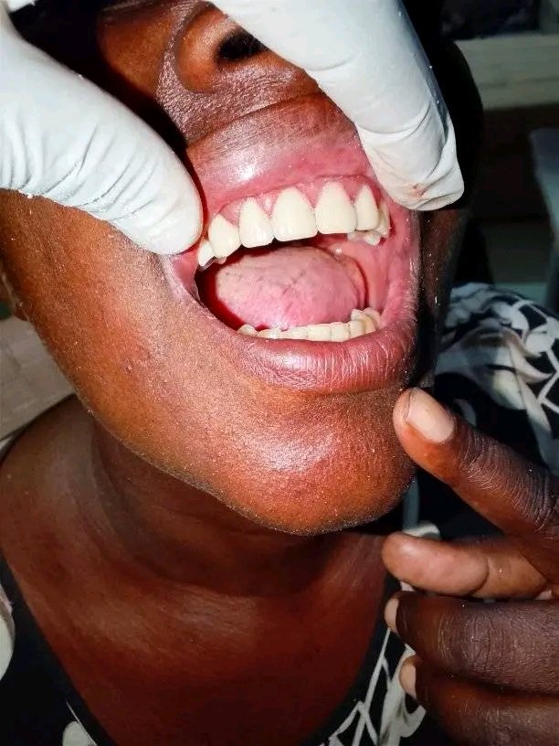 PalaceCent41947's tweet photo. Missing teeth shouldn’t stop you from smiling confidently.

A real **Before &amp; After** transformation with **bridges/crowns**, restoring both appearance and function.

📍 KTDA Plaza, 5th Floor, Moi Avenue, Nairobi CBD
📞 0722 396 174
🌐 https://t.co/VwnAUpeTPv

#NairobiCBD https://t.co/XAQskIk1rV