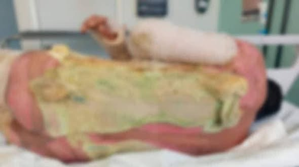 lunadeandromeda's tweet photo. Esto NO es una exageración. Es una denuncia REAL.
En la Clínica 46 del IMSS en Villahermosa, Tabasco, un hombre con quemaduras de tercer grado está siendo abandonado… literalmente entre infección, dolor y olor a putrefacción.
Su nombre es Fredi Landero de la Cruz.
Su esposa, Alejandra Brito, suplica ayuda.
 Desde diciembre, tras un accidente laboral, su cuerpo está lleno de heridas abiertas.
 El último lavado quirúrgico fue el 22 de enero. Hoy, sus heridas SUPURAN pus.
 El olor es tan fuerte que —según su familia— ya hay moscas rondando su cuerpo.
 Necesita un injerto de piel urgente, pero le dijeron que “no hay equipo”… incluso que la familia tendría que RENTARLO.
¿Así trata el sistema de salud a un ser humano?
Fue enviado al Hospital de Especialidades No. 14 del IMSS en Veracruz…
y lo regresaron SIN ATENDERLO, en la misma ambulancia.
Hoy sigue ahí. Esperando. Deteriorándose. Sufriendo.
 Clínica 46 IMSS Villahermosa
Cama 336 — Tercer piso
 COMPARTE. COMENTA. ETIQUETA. HAZ RUIDO.
Que esto llegue a autoridades, medios y derechos humanos.
Nadie merece vivir algo así en una cama de hospital.
HOY ES ÉL… MAÑANA PODRÍA SER CUALQUIERA