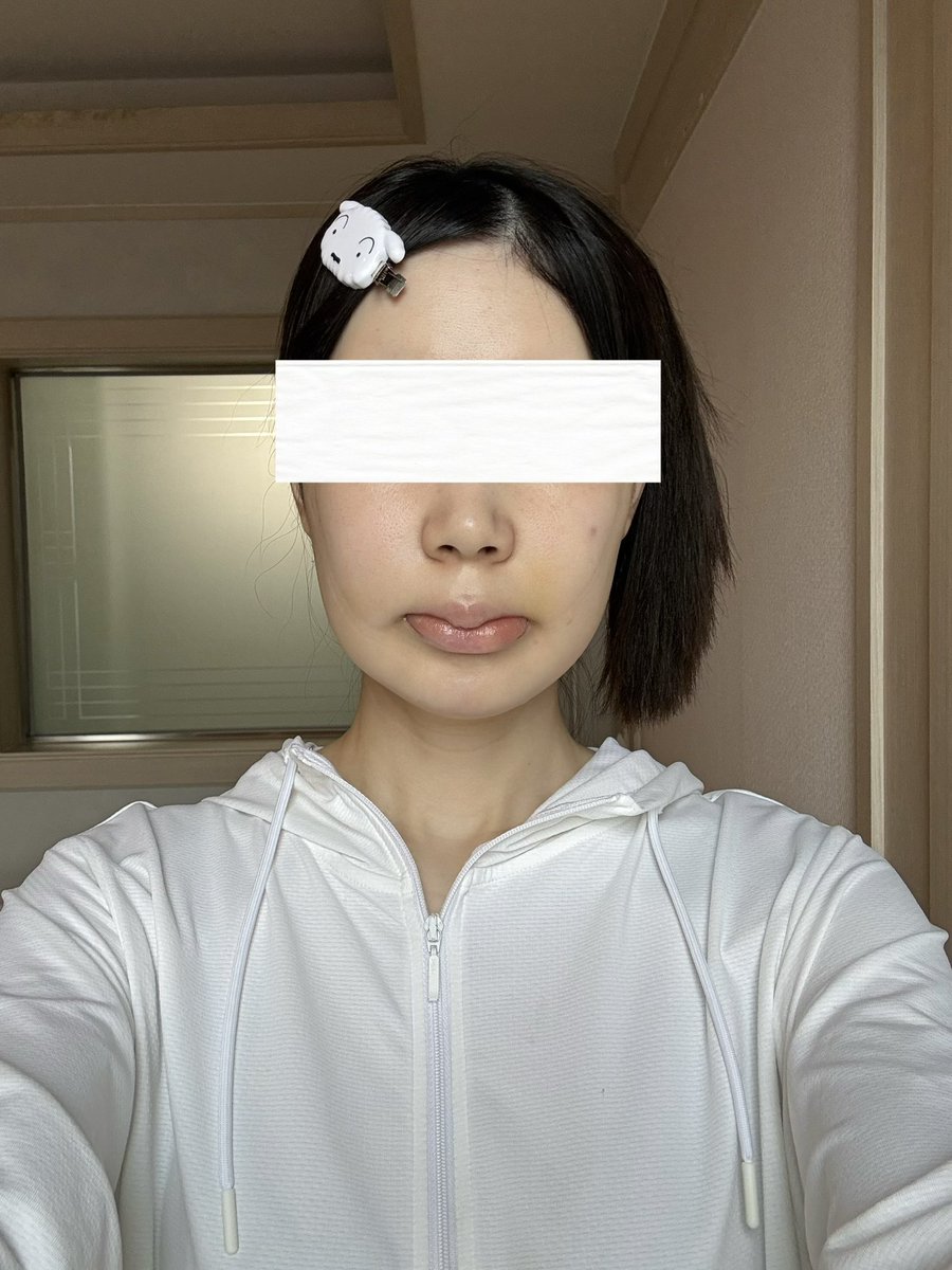 xq20ae's tweet photo. MACS 両顎＋輪郭3点
DT 9日目 https://t.co/OmKRC4sMcI