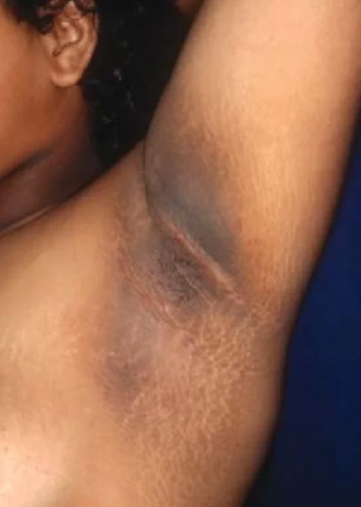 icalbhimaa's tweet photo. Kanker tidak selalu diawali dengan rasa nyeri. Terkadang, tanda awalnya justru muncul pada perubahan kulit.

Ada 7 perubahan kulit yang berkaitan dengan kanker di dalam tubuh.

1. Leher, ketiak, atau selangkangan tiba-tiba menghitam dan menebal. https://t.co/0ev4Y3VOX7