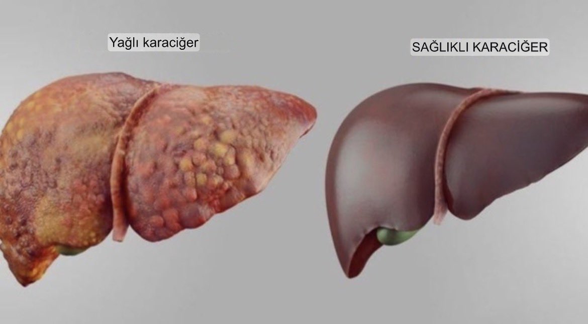 bilgibilgi_1's tweet photo. Ne kadar su içersen iç, karaciğerini temizlemezsen ŞİŞMİŞ YÜZÜ ve sıvı tutulmasını ortadan kaldıramazsın.

Her gün bu 7 besini tüketerek başla: https://t.co/Uz2CooolBh