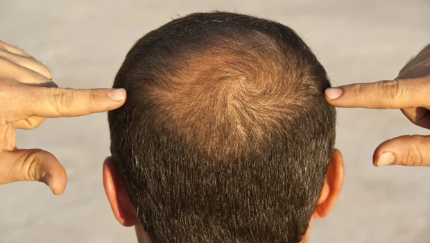 Hurriyet's tweet photo. 💇‍♂️Saç dökülmesi yaşayan erkekler, ilaç veya cerrahi saç ekimi yerine kafa derisi mikropigmentasyonuna yöneliyor.

▪️Binlerce küçük pigment noktasıyla tıraş edilmiş saç görünümü oluşturan yöntem, birkaç seans içinde dikkat çekici bir değişim sağlayabiliyor.

📲Sosyal medyada milyonlarca kez izlenen öncesi-sonrası görüntüleriyle popülerleşen uygulama yeni saç çıkarmıyor. 

👉Yalnızca kafa derisini renklendirerek saçların daha yoğun olduğu izlenimini yaratıyor.