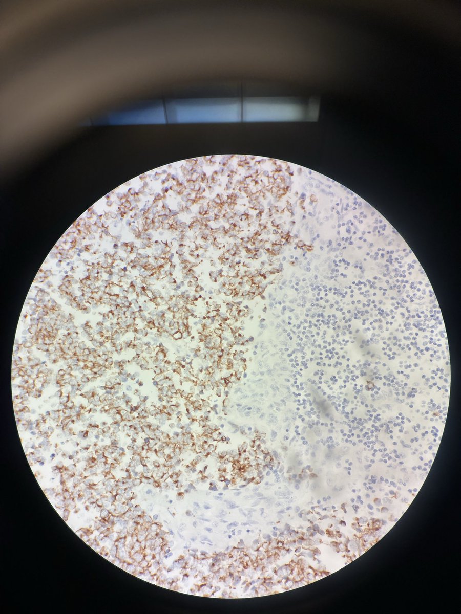 CytoPapGuy's tweet photo. Today’s interesting case: 50s F with parotid lesion - IHC panel shown is first, Synaptophysin; second, CK20 (seen are some dot-like points) - what’s the diagnosis? 
#pathology #cytopath #cytopathology #pathologyresidency #cytology #medicine #medschool https://t.co/xZNcW2qHWg