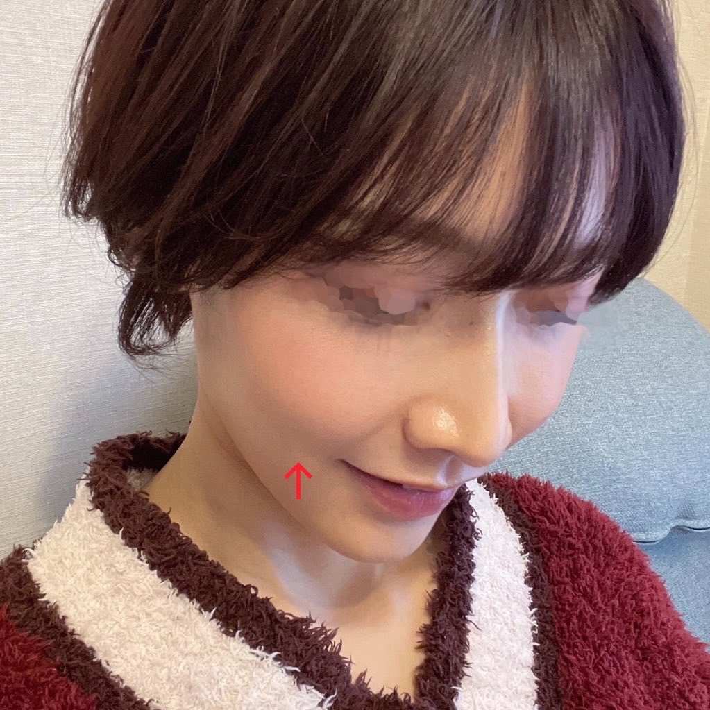 babu_yanagawa's tweet photo. 引用失礼します！

この、頬肉アンパンマンと頬骨の辺縁は、実は"脂肪"のケースが多いです。

下側は、メーラーファットという、中顔面のお肉の外側です。

注意しないといけないのは、メーラーファットを取り過ぎると中顔面の立体感が失われるので、チークトップは高い位置に保ちつつ、下の部分だけ除去するのが必要です☝️

さらにチークボーンファットという頬骨の上にあるお肉も取ることで、凸凹をなくして影を無くせます。

皮膚のたるみがある場合は、クォンタムで皮膚を"ピタッ"と骨につけるようにします。

"影を無くして滑らかにする"こそ、当院が毎日行っているパターンで、ここに関しては去年の国際学会で発表しています。

この影で悩んでいる方はぜひお任せくださいませ✨