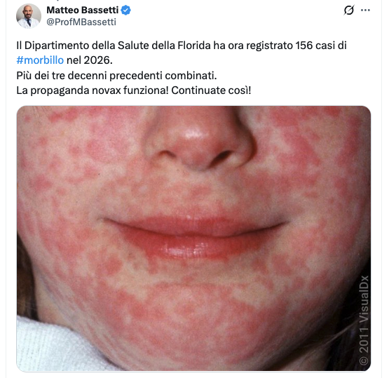 Pinperepette's tweet photo. 156 casi, zero morti. Quando ero bambino il morbillo era una delle classiche malattie esantematiche che “si dovevano fare”. Oggi basta un numero senza contesto per trasformare un dato epidemiologico in propaganda. https://t.co/CkNxn6RRKp