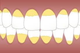 questmoosa's tweet photo. Yellow teeth are you body's sign of an improper calcium-to-phosphrous ratio.

When you consume excessive phosphate 90% of the time (excessive grains,seeds,nuts etc) - a hormone called PTH is raised which can strip calcium from the bone and also harm dental health.

The BEST ways to lower PTH to improve dental (and even kidney) health is to:

- Fix vitamin D, calcium and magnesium deficiency
- Drinking milk lowers parathyroid hormone
- Consume high amounts of cheese
- Reduce excessive phosphate in the diet (less high phosphate diet)
- Vitamin K2 and buteyko breathing (more on CO2 below)

Most people with yellow teeth also suffer from hairloss, further signalling elevated PTH, vascular calcification and reduced metabolism/CO2 production as CO2 is also needed for the proper use of K2 and fat-soluble vitamins and also for adeuqate vasodilation and blood-flow for the cells in the scalp and teeth - for regeneration and maintenance.

Your yellow teeth signals an improper physiology and is not your cue to spend $9997 on dental whitening but rather to FIX YOUR CELLULAR METABOLISM!